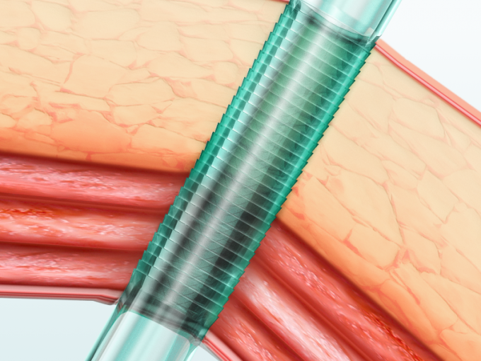 Cânula descartável de Trocar dos instrumentos Laparoscopic com lâmina 0