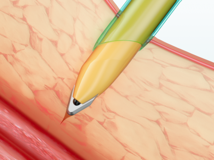 Cânula descartável de Trocar dos instrumentos Laparoscopic com lâmina 1