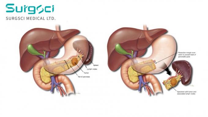 últimas notícias da empresa sobre Pancreatectomia distal: procedimento, indicações e papel do bisturi ultra-sônico.  0